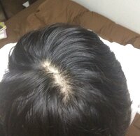 これはつむじハゲですか つむじハゲには見えませんよ 分 Yahoo 知恵袋