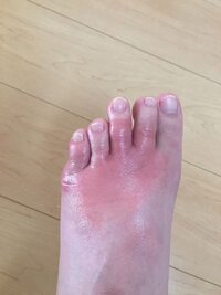 先日から足の指付近が我慢出来ないほどの痒みがあり つい掻いてしまってい Yahoo 知恵袋