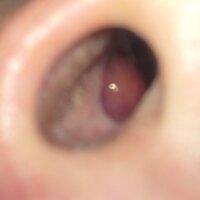 鼻の粘膜について 両方このような鼻の粘膜があるのですが 右側 Yahoo 知恵袋