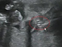 妊娠25週です 今日は妊婦検診でした このエコー写真の3本線 Yahoo 知恵袋