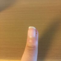 4日前くらいから 爪ささくれの根元に緑の膿があります Yahoo 知恵袋