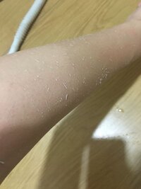 風呂上がって体拭いてたら腕からこんな白いのがいっぱい出てきま Yahoo 知恵袋