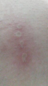 最近肌に白いぽつっとしたできもの ができました できたのは太 Yahoo 知恵袋