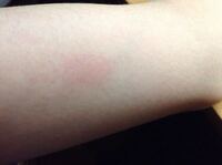 アルコールパッチテストについて 絆創膏に消毒液を垂らして貼る方法を Yahoo 知恵袋