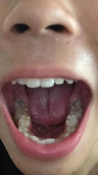 歯に黒い線 点 がたくさんあります これは虫歯ですか Yahoo 知恵袋