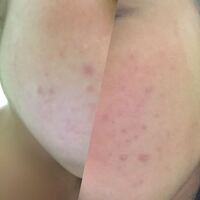 急ぎ 中学生3年です 最近肌荒れがひどくて困っています 思春 Yahoo 知恵袋