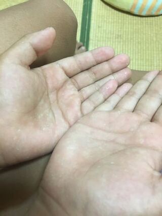 皮 子供 の むける 手 が