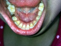 画像閲覧注意 歯茎下がりについて 中学生の女子です 歯茎が下がっ Yahoo 知恵袋