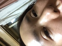 フォーエバー二重術について質問します 昨日日曜に湘南美容クリ Yahoo 知恵袋