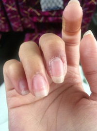 指についてです ストレスと元々ささくれが気になるタチで剥いてたのですが Yahoo 知恵袋