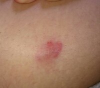 乳がんでしょうか 炎症性乳がんでしょうか それともただの皮膚炎でしょう Yahoo 知恵袋