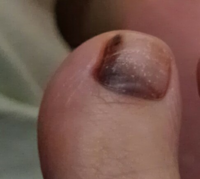 数ヶ月前に足の親指の爪の端に黒く汚れたような物がありました 血豆かとお Yahoo 知恵袋