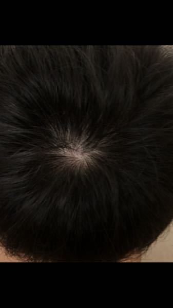 つむじに渦が巻いてないのですが ハゲてしまうのでしょうか そして Yahoo 知恵袋