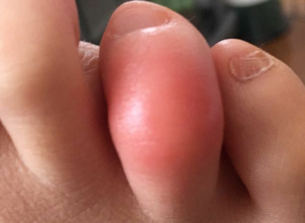 ここ2 3日足の指一本だけがものすごく痒いです 真っ赤に腫れてます 消 Yahoo 知恵袋