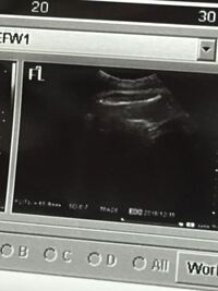 38w現在３人目妊娠中です このエコー写真で見える３本 Yahoo 知恵袋