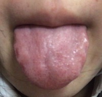 が 舌 でこぼこ ふち の 【写真で見る】舌の病気・できもの辞典