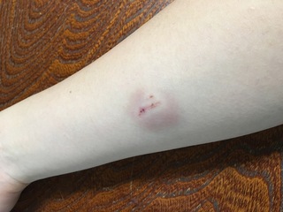 昨日腕を犬に噛まれました 出血もほとんどなかったため 水で洗ってそのま Yahoo 知恵袋