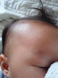湿疹がひどい赤ちゃんの百日記念写真について もう少しで百日を迎える子 Yahoo 知恵袋