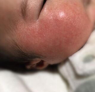 アズノール 赤ちゃん 炎症や痒みに使えるアズノール軟膏 市販でも買える