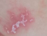 赤ちゃんのおむつかぶれ ５日前 病院で塗り薬を貰いました Yahoo 知恵袋