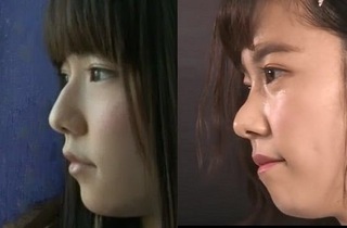 島崎遥香の鼻 ついに整形なさったんでしょうか 整形ですね 今回は Yahoo 知恵袋