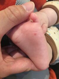生後4ヶ月の赤ちゃんがいます 足の裏に赤いニキビみたいなのができ Yahoo 知恵袋