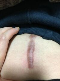 帝王切開の傷跡についてお伺いしたいです 傷の写真がある Yahoo 知恵袋