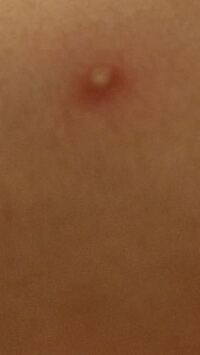 胸の上らへんに変なできものができて気持ち悪いです しらべたら乳がん の Yahoo 知恵袋