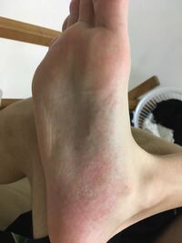 何もしていないのに足の裏が痒いです ムヒを塗ってもいいのでし Yahoo 知恵袋