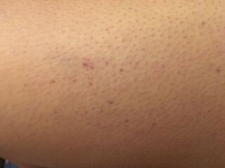 昨日お風呂で足が痒くてかいていたら 今日起きてみた時に太もも Yahoo 知恵袋