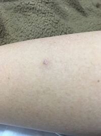 いつの間にか腕に白いできもの みたいなのができたんですがなに Yahoo 知恵袋