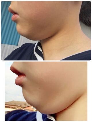 アデノイド顔貌ですか ただデブなだけですか 下の画像はあごを引き Yahoo 知恵袋