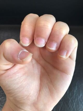 中学3年女子です 私は小さい頃から爪を噛むくせがあって 爪がとても小さ Yahoo 知恵袋