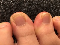 足の爪の横線足の親指の側面だけに横線ができます 親指は巻き爪 Yahoo 知恵袋