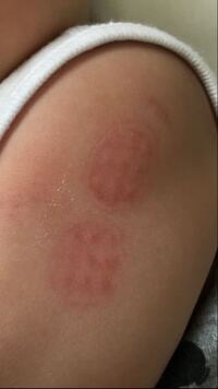 昨日5ヶ月の娘のbcgの予防接種がありました 事前に 接種後は乾か Yahoo 知恵袋