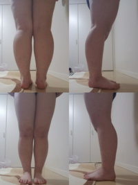 足が太すぎる ダイエットをして10キロ弱痩せたのですが下半身だけ Yahoo 知恵袋