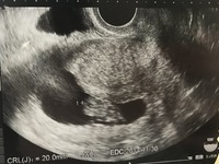 エコー写真についての質問です 先日の9wのエコー写真です ほかの方の9 Yahoo 知恵袋