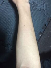 気づいた時には二の腕と腕に謎の白い線ができていました 下は腕の写真ですが Yahoo 知恵袋