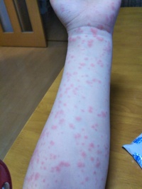 薬疹はどれくらいでかゆみがおさまりますか 薬疹が出た事があ Yahoo 知恵袋