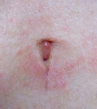 腹腔鏡手術後の おへそ のことで 6週間前に腹腔鏡で虫垂炎の Yahoo 知恵袋