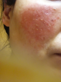 画像あり 気持ち悪いの嫌いな方はみないで下さい 汚い肌をさら Yahoo 知恵袋