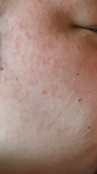 汚い肌ですがどうか教えてください 私は 脂性 汗かき 顔がほ Yahoo 知恵袋