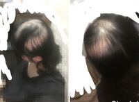 髪の毛が異常に抜けるんです 37歳 女性です 髪を洗う時 Yahoo 知恵袋