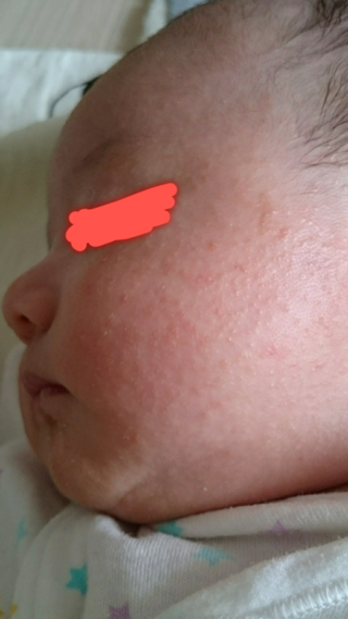 赤ちゃんの湿疹について 生後１ヶ月一週間の男の子です 産まれたと Yahoo 知恵袋