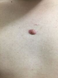 19の男です 僕の胸には赤いおでき がありますこれどうにかした方が Yahoo 知恵袋