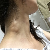 おとといの夜 右首側面にしこりがあるのを発見し鏡で確認すると Yahoo 知恵袋