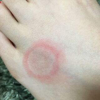 画像有り虫刺され のような赤く少しかゆみのあるものが急にで Yahoo 知恵袋