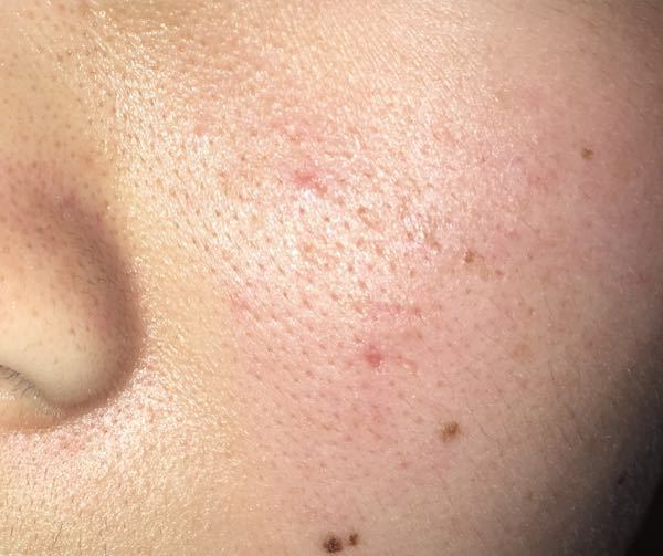 毛穴と赤みとニキビ跡は どうやったらなおりますか Yahoo 知恵袋