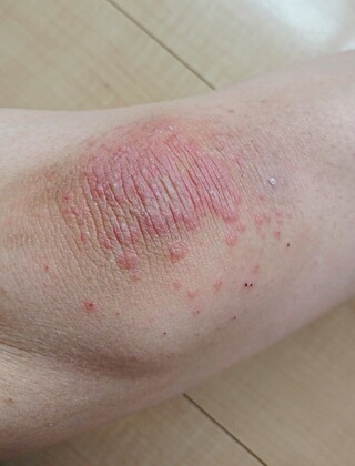 膝の湿疹 汚い画像ですみません ここ一週間ほど 両膝にのみポツポツと湿 Yahoo 知恵袋