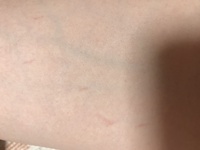 これは肉割れの前兆ですか 太ももの外側の付け根やお尻にはできてて 毎日 Yahoo 知恵袋